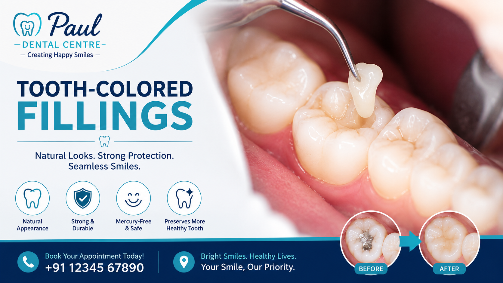 Tooth-Colored Fillings
